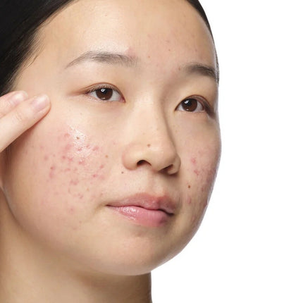 The Ordinary Blemish Control Aloe 2% + NAG 2% Solution Serum - 30ml