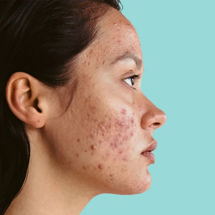 Drs Leenarts Day & Night Cream Oily/Acne-Prone Skin - 50ml